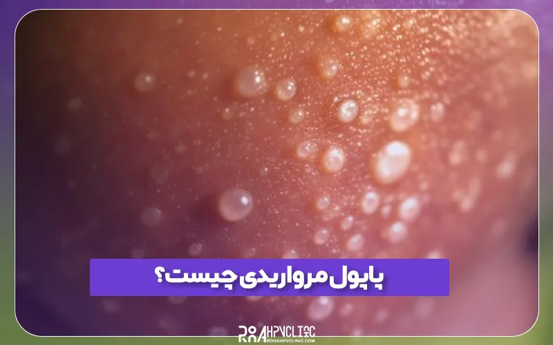 پاپول مرواریدی چیست و چه علائمی دارد؟