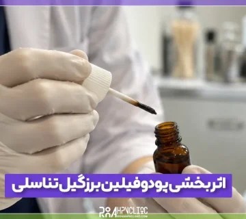 اثربخشی پودوفیلین بر زگیل تناسلی زنان و مردان