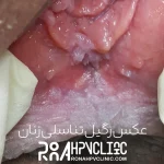 عکس زگیل تناسلی در زنان-1