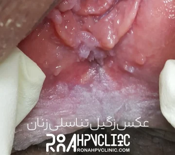 عکس زگیل تناسلی در زنان-1