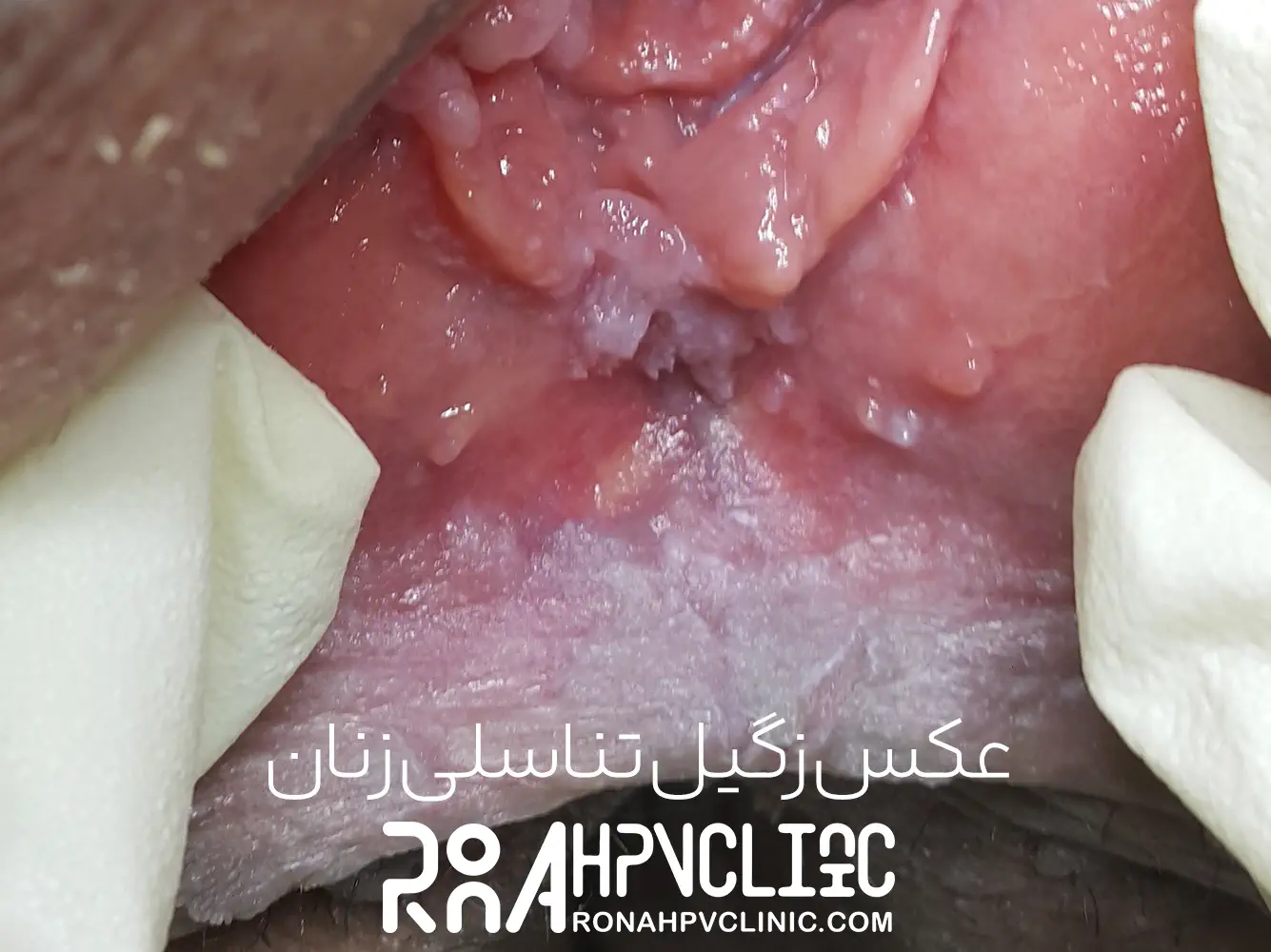 کلینیک hpv رونا 162 عکس زگیل تناسلی در زنان-1