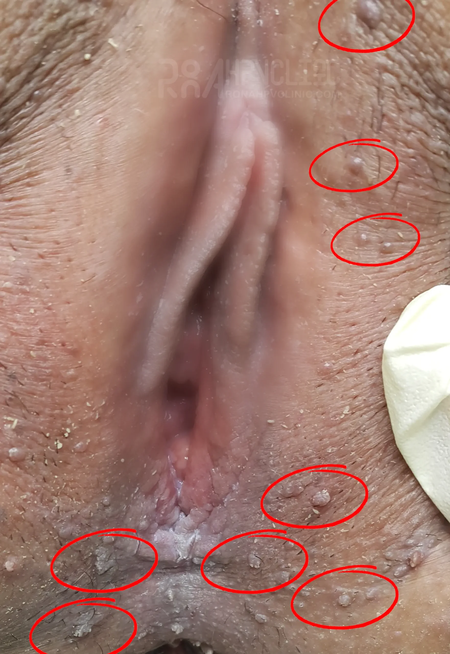 عکس زگیل تناسلی زنان