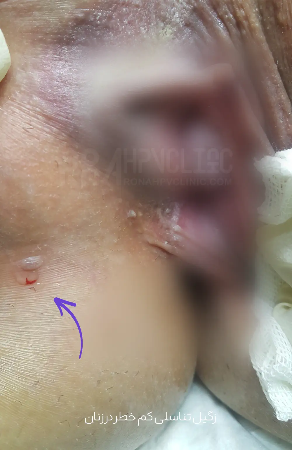 عکس زگیل تناسلی کم خطر در زنان