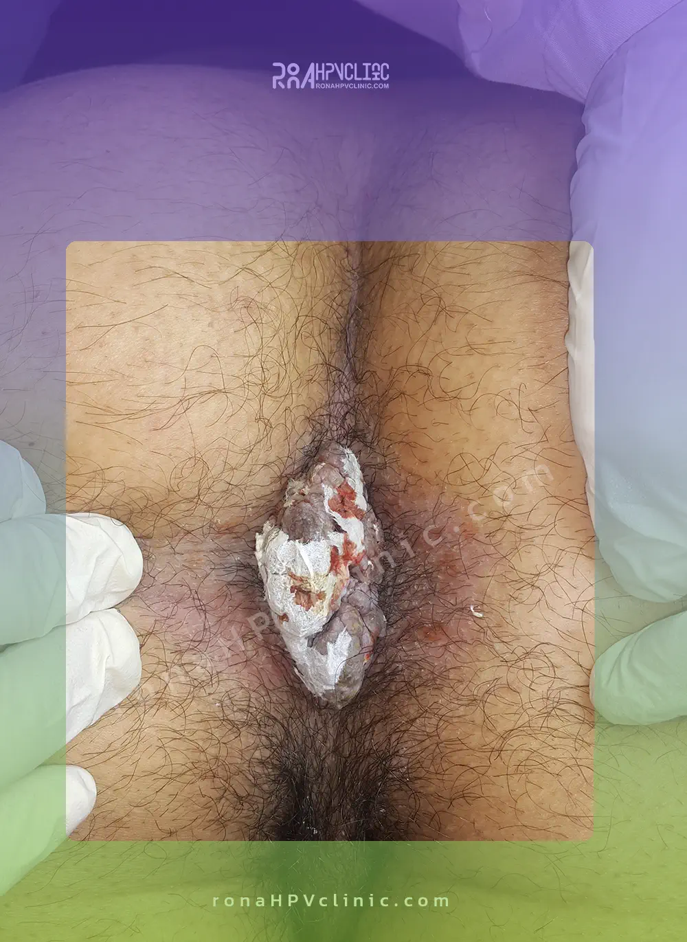عکس زگیل مقعدی و بواسیر
