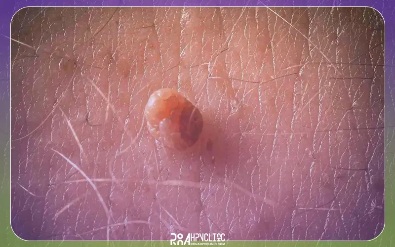 12 بیماری مشابه زگیل تناسلی + مقایسه و تفاوت آنها 5 راه تشخیص بیماری های مشابه زگیل تناسلی
