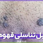 زگیل تناسلی قهوهای