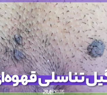 زگیل تناسلی قهوهای