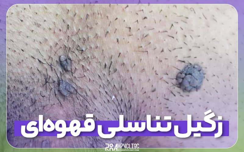 زگیل تناسلی قهوهای