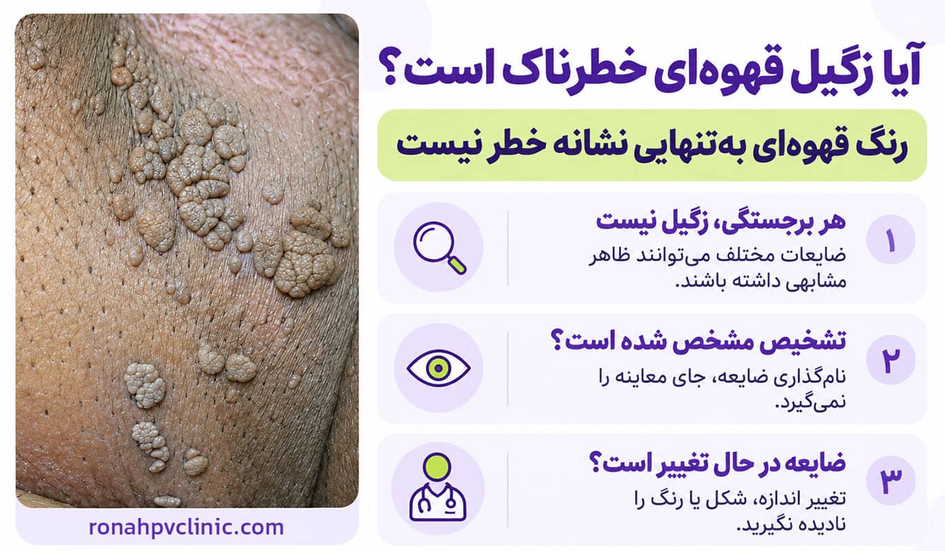 زگیل تناسلی قهوهای علائم و درمان زگیل قهوه ای روی پوست 11 زگیل تناسلی قهوه ای