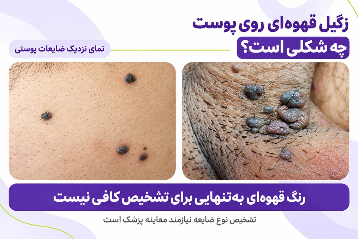 زگیل تناسلی قهوهای علائم و درمان زگیل قهوه ای روی پوست 7 زگیل قهوهای