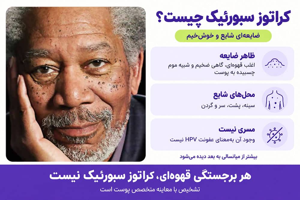 کراتوز سبورئیک